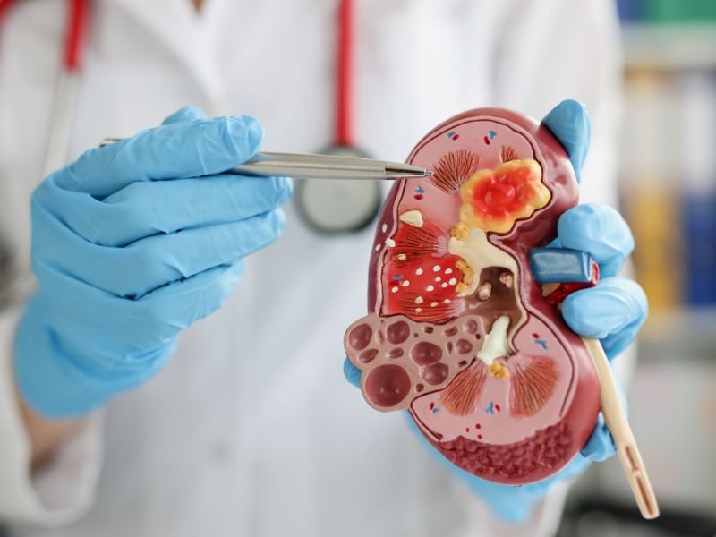 Cirurgia de Pedra nos Rins em Curitiba Tratamento Avancado e Seguro