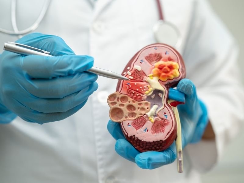 Cirurgia de pedra nos rins sem corte Curitiba