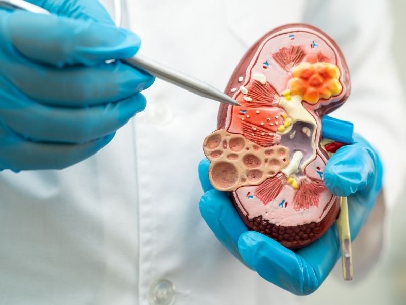 Tratamento avancado calculo renal Curitiba